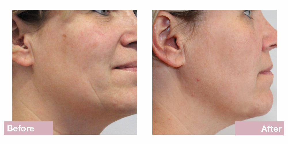 Dermatude Andlitsmeðferð Dharma Snyrtistofa 39